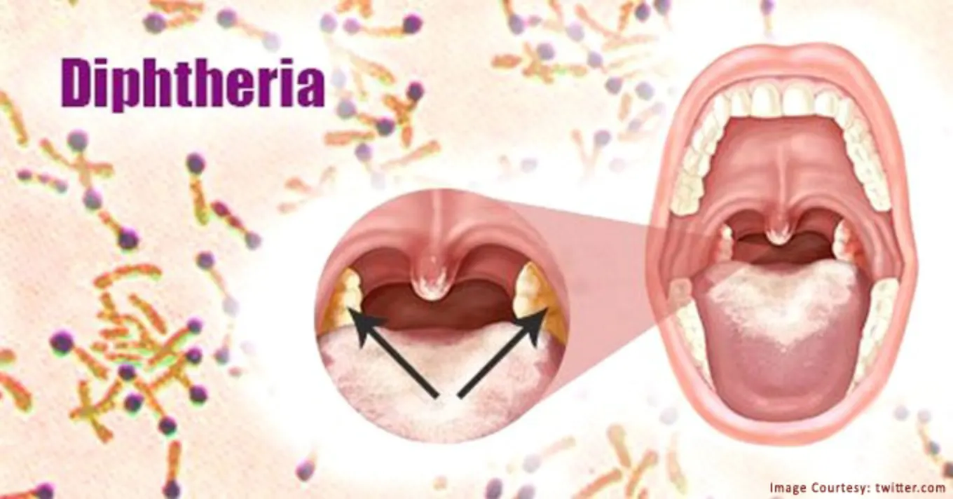 Diphtheria Symptoms Causes And Treatment The Fit Body