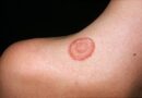 Ringworm – Symptoms, Causes and Treatment